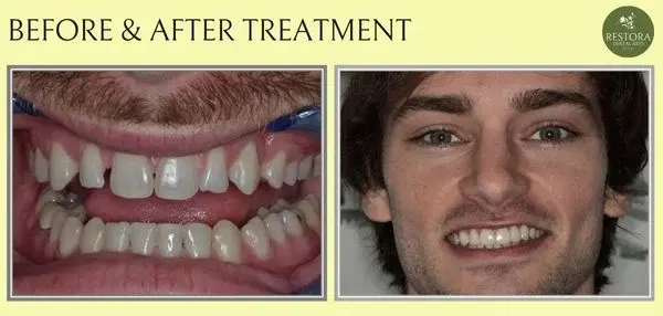 Before and after treatment at Restora Dental Arts