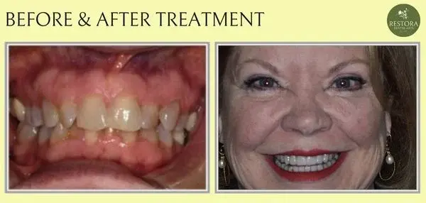 Before and after treatment at Restora Dental Arts