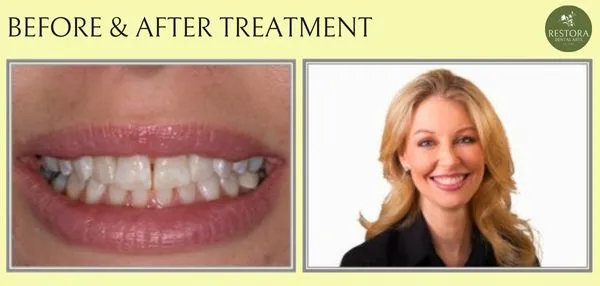 Before and after treatment at Restora Dental Arts