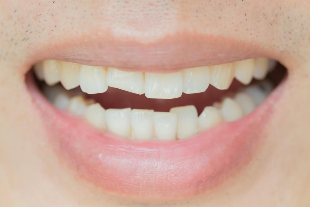Dental Treatment at Restora Dental Arts Austin Texas