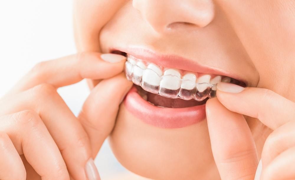 Invisalign Dental Treatment at Restora Dental Arts Austin Texas