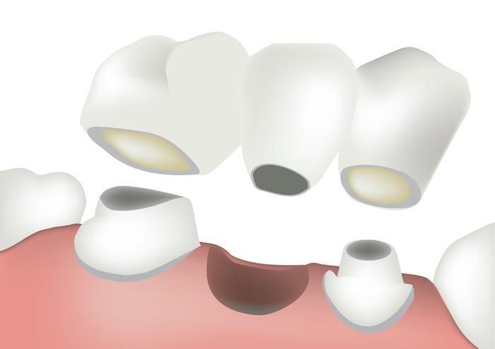 Dental Treatment at Restora Dental Arts Austin Texas