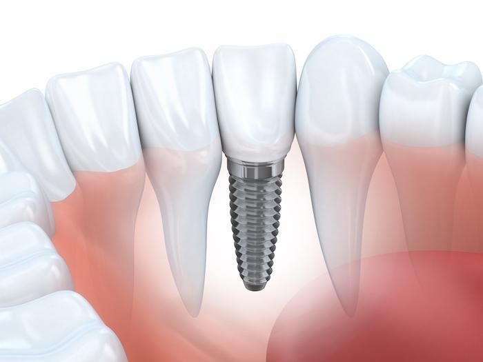 Dental Treatment at Restora Dental Arts Austin Texas