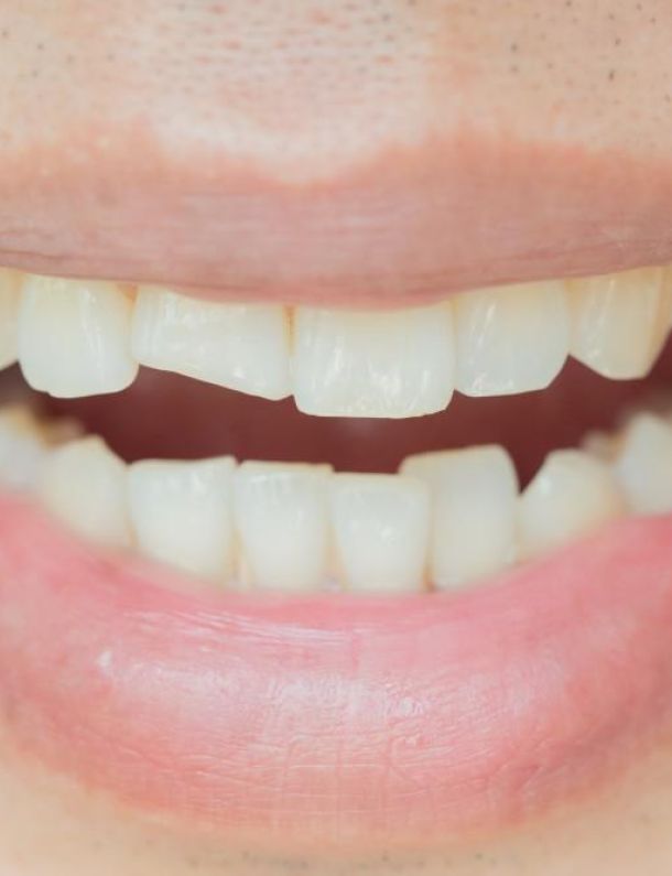 Dental Treatment at Restora Dental Arts Austin Texas